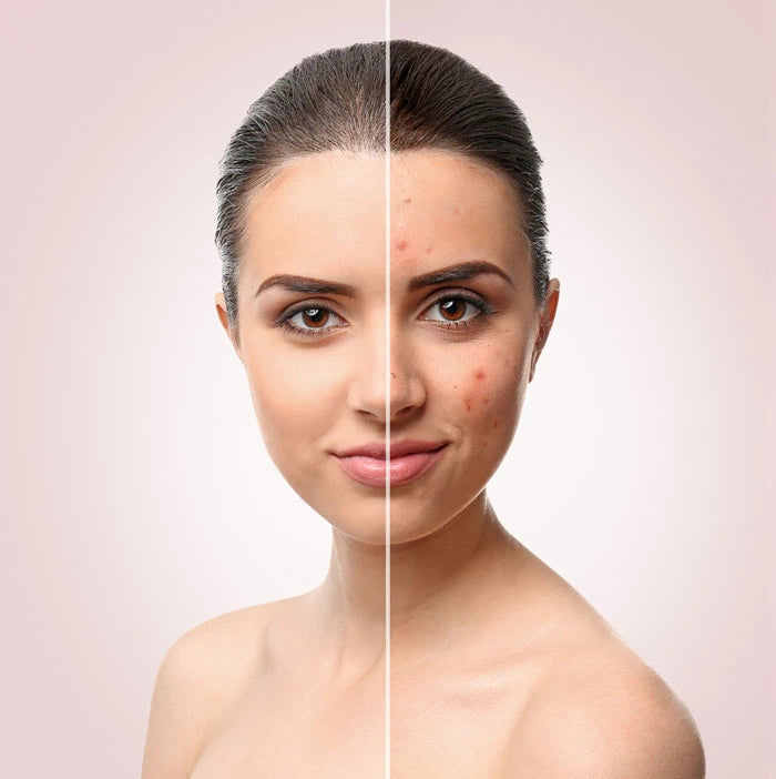 How to Get Rid of Acne||How to Get Rid of Acne||How to Get Rid of Acne