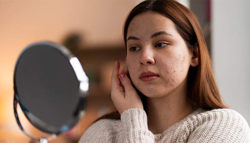 Natural Ways to Reduce Hyperpigmentation and Dark Spots from Within