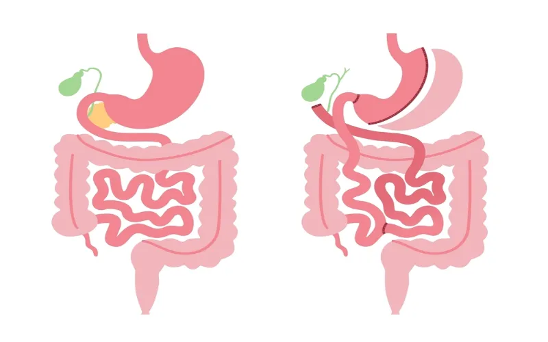 High Fat Diets Induced Inflammation & Gut Dysbiosis