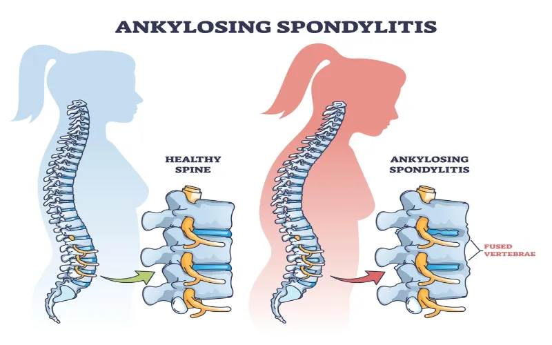 Ankylosing Spondylitis & Human Microbiome