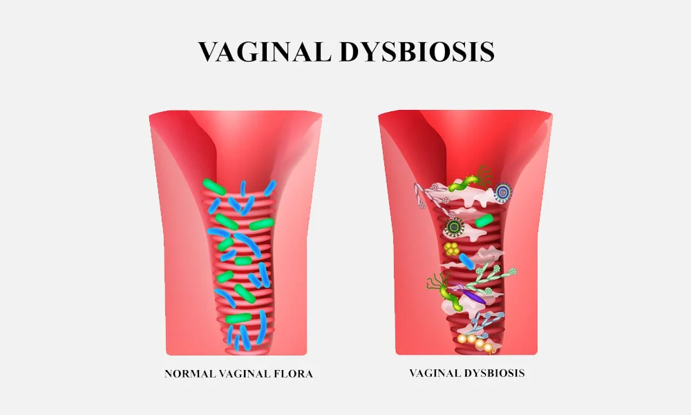 Vaginal Dysbiosis