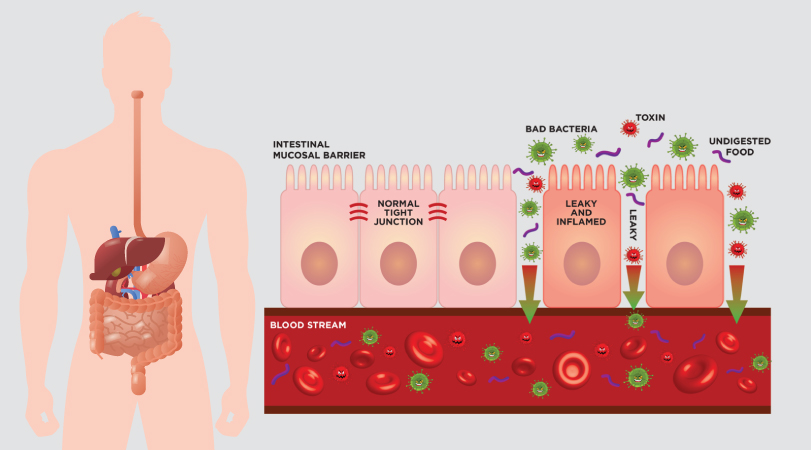 Leaky Gut Weight Gain Explained