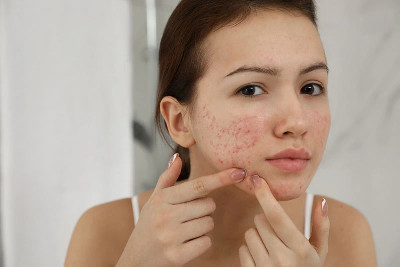 How to Get Rid of Acne 