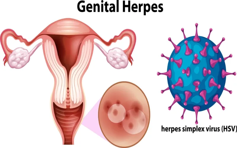 genital-herpes-infection