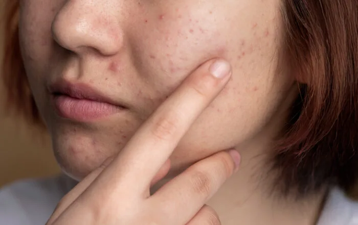 hormonal acne