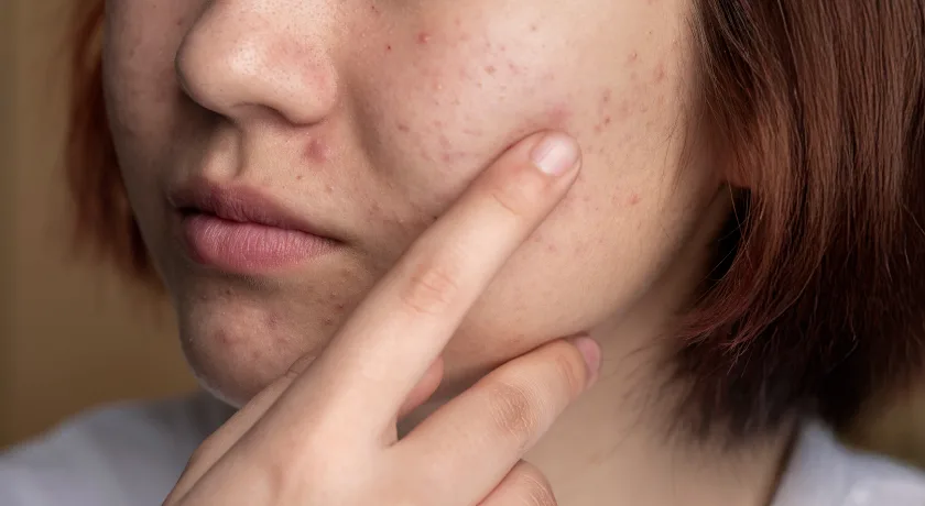 hormonal acne