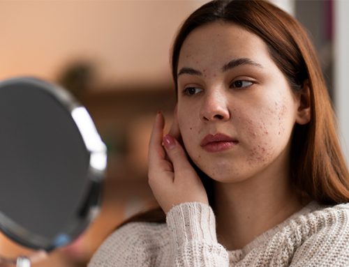 Natural Ways to Reduce Hyperpigmentation and Dark Spots from Within